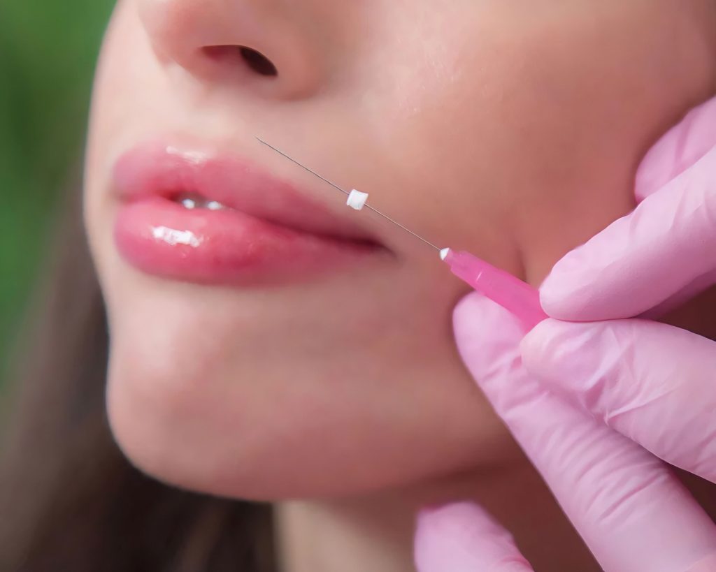 PDO Thread Being Inserting In Upper Lip